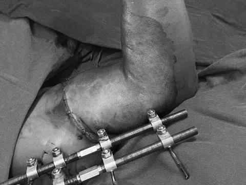 5 tiếng phẫu thuật nối lại cánh tay đứt rời cho người đàn ông