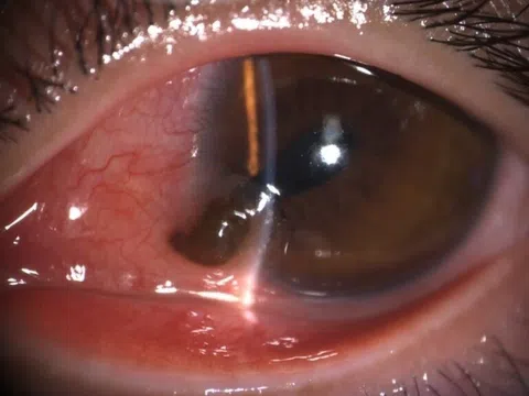 Nam thanh niên bị đinh bắn xuyên mắt khi đang làm việc