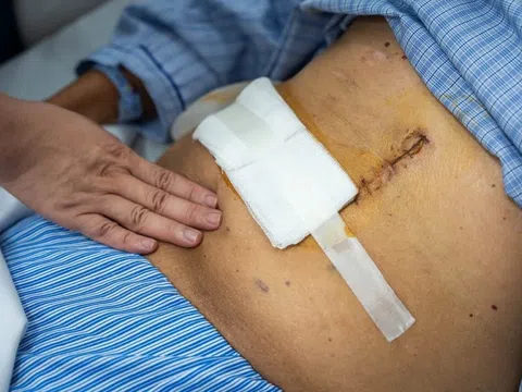 Thói quen giải khuây mỗi ngày đẩy người đàn ông vào ung thư dạ dày