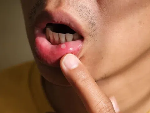 Những triệu chứng cảnh báo ung thư ở nam giới giai đoạn đầu