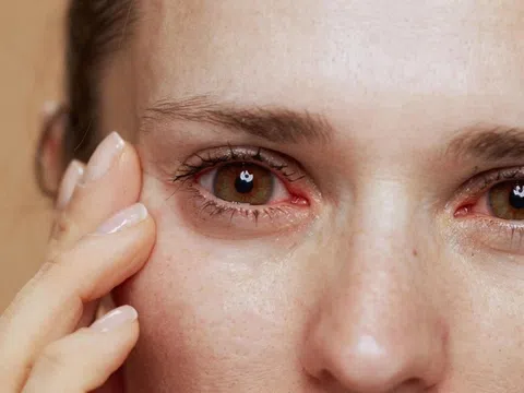 Triệu chứng gan yếu biểu hiện ở mắt