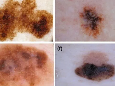 Đốm đen trên da, khi nào là dấu hiệu của ung thư da?