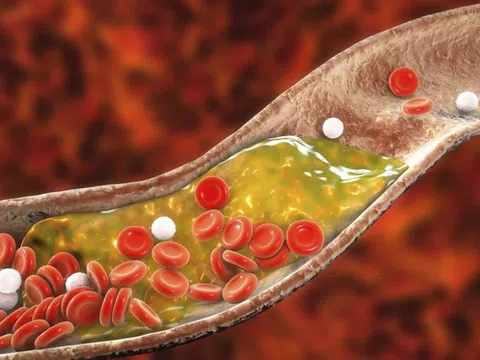 Loại nước đơn giản càng uống càng giúp giảm cholesterol