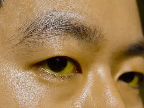 Dấu hiệu cảnh báo bệnh gan biểu hiện trên mặt