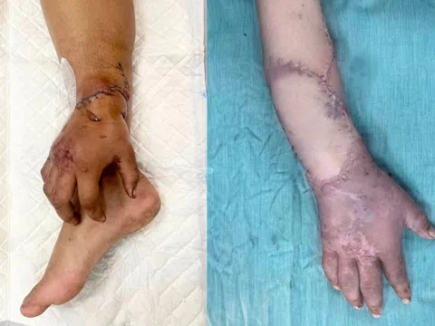 Nối lại bàn tay cho sản phụ, sau 2 tháng được ghép tạm vào chân