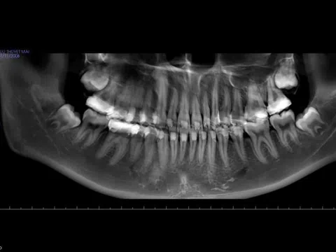 Bác sĩ hướng dẫn tránh sai lầm sau nhổ răng khôn - 'vị khách' đến muộn nhiều phiền toái