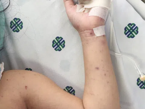 Viêm màng não do não mô cầu tăng, ai cần cẩn trọng?