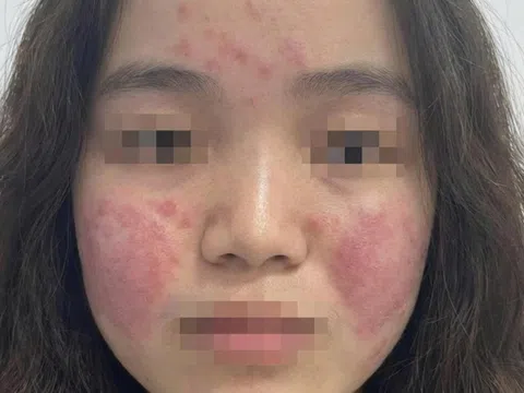 Cô gái trẻ đỏ rát mặt vì ô nhiễm không khí, bác sĩ hướng dẫn cách bảo vệ da