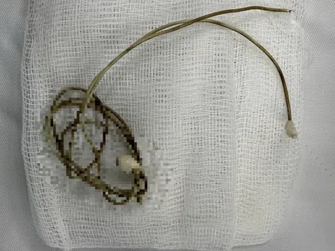 Nam sinh phải mổ khẩn vì dây sạc điện thoại trong bàng quang sau khi bắt chước clip trên mạng