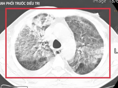 Người đàn ông trở về từ Thái Lan, mang theo vi khuẩn 'tử thần'