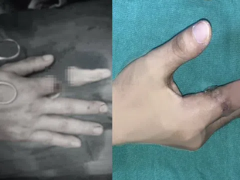 Người đàn ông nhập viện với ngón tay đứt lìa bỏ trong bình giữ nhiệt