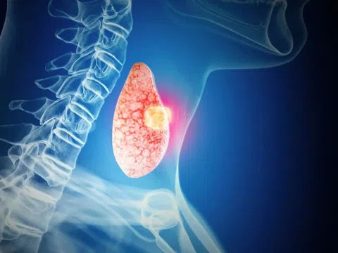 Loại ung thư có số ca mắc cao nhất Bệnh viện Ung bướu TP.HCM