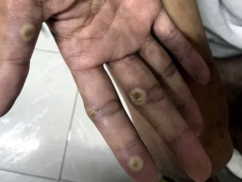 Đồng Nai xuất hiện ca đậu mùa khỉ chưa rõ nguồn lây, ngành y tế khẩn trương truy vết