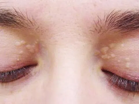 Dấu hiệu mỡ máu cao biểu hiện ở mắt