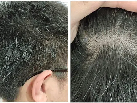 Có phải ‘tóc bạc nhiều là dấu hiệu của ung thư’?