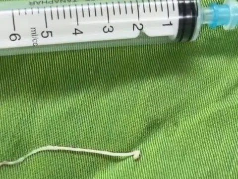 Phát hiện ổ sán ký sinh ở một nơi không ngờ trong cơ thể