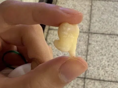 Răng khôn có nhất thiết phải nhổ không?