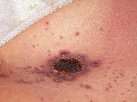 Những ca phát hiện HIV khiến bác sĩ 'giật mình'