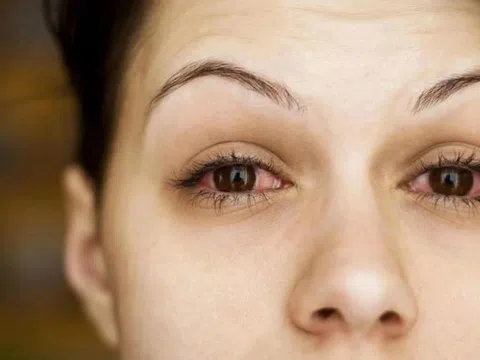 Triệu chứng của huyết áp cao biểu hiện ở mắt