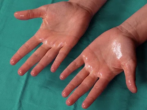 Ra mồ hôi tay chân nhiều cảnh báo những bệnh lý nào?