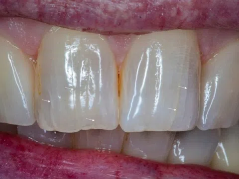 Tưởng vô hại, các vết rạn trên răng có thể gây rắc rối lớn