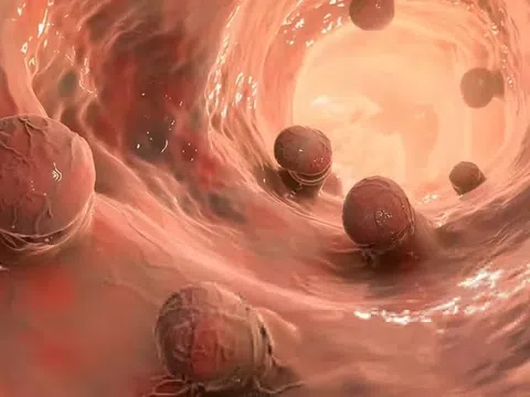 90% ung thư đại trực tràng khởi phát từ vị trí này