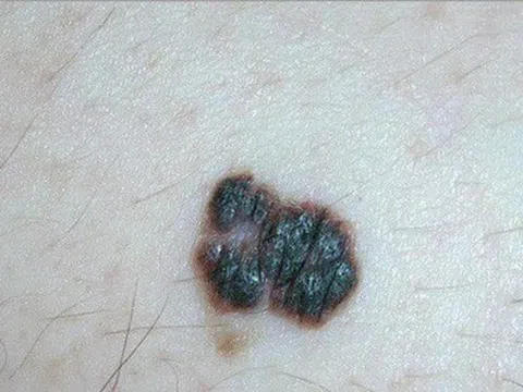 Đốm đen ở lòng bàn chân suýt cướp mạng người đàn ông trẻ