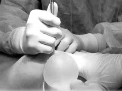 Cô gái bị biến dạng ‘vòng 1’ sau khi tiêm filler HA nâng ngực