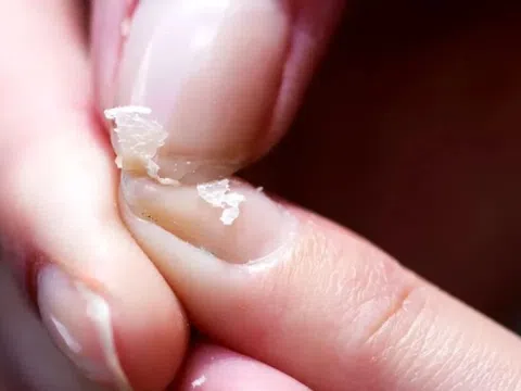 Biểu hiện thiếu máu không nên bỏ qua