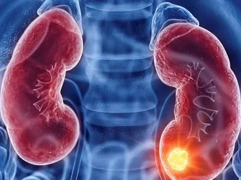Cảnh báo quan trọng của ung thư thận