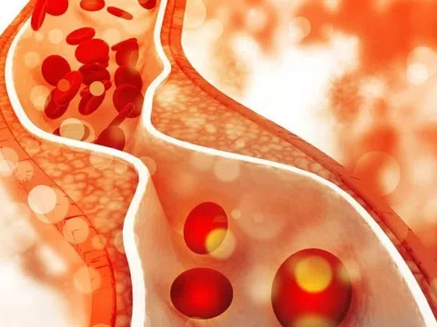 Dấu hiệu khi tăng triglycerid máu