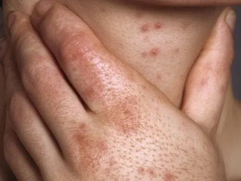 Một bệnh lây qua tình dục đang lan rộng ở nhiều nước châu Á