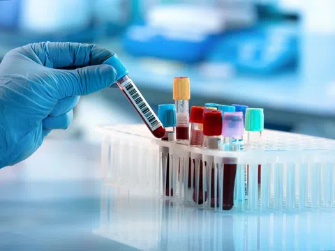 Đường lây truyền HIV mạnh mẽ nhất