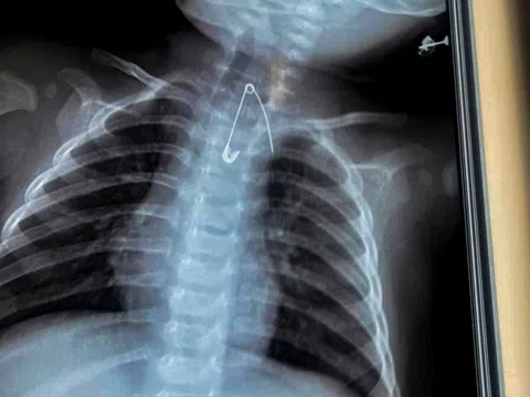 Cứu sống hai em bé nuốt kim băng và cây kẹo mút