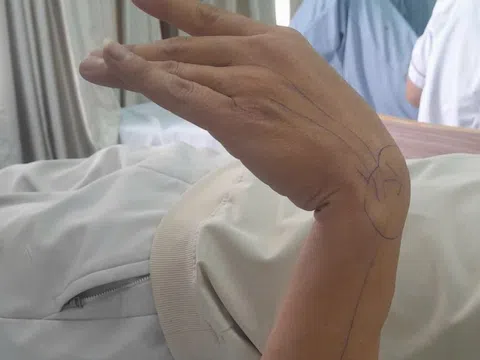 Ngủ gật gối đầu lên tay, người đàn ông 37 tuổi bị liệt thần kinh quay