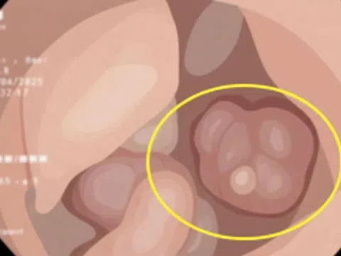 Người đàn ông có 3 dấu hiệu của bệnh ung thư nhưng không biết