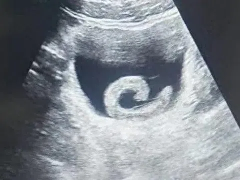 Người đàn ông phải nhập viện cấp cứu vì đỉa sống trong bàng quang