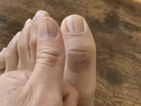 Dấu hiệu lạ trên móng chỉ báo mắc ung thư nguy hiểm