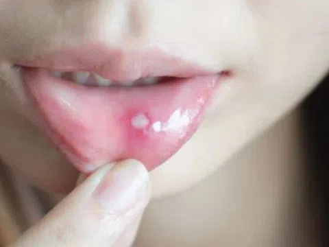 Đi khám càng sớm càng tốt nếu thấy vết loét này trong miệng