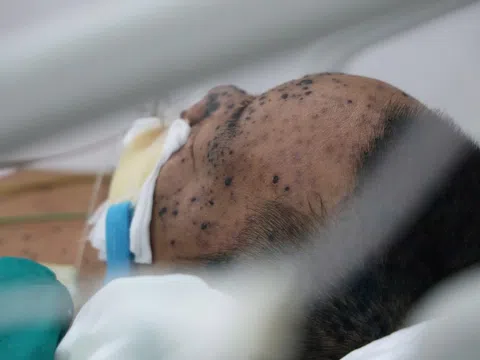 Chủ quan lây bệnh từ con, người đàn ông 36 tuổi nguy kịch