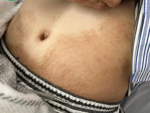 Món khoái khẩu khiến cô gái nhiễm 4 loại ký sinh trùng