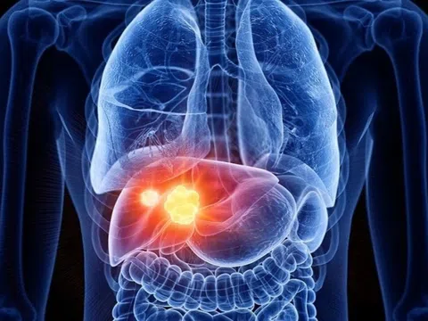 3 lý do khiến người Trung Quốc mắc ung thư gan ngày càng nhiều