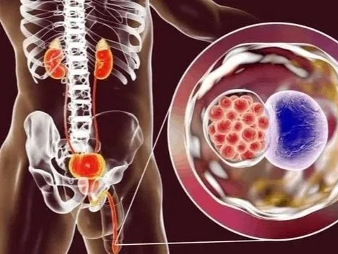 3 bệnh lây truyền qua đường tình dục làm tăng nguy cơ ung thư