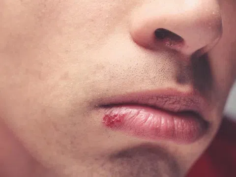 Chủ quan vết loét nhỏ ở miệng, người đàn ông mắc ung thư sau một năm
