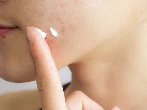 Thu hồi 8 sản phẩm mỹ phẩm chứa thuốc chống nấm trên toàn quốc