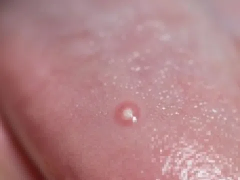 Dấu hiệu bệnh nguy hiểm biểu hiện ngay ở lưỡi