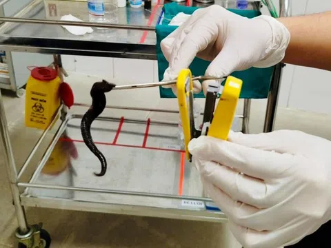 Bác sĩ gắp dị vật khó tin từ hốc mũi người bệnh