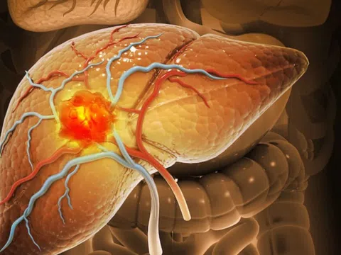 Dấu hiệu gan gặp vấn đề dễ nhận thấy vào ban đêm