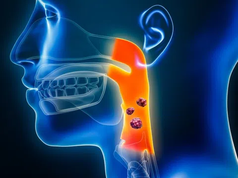 Triệu chứng ung thư vòm họng giai đoạn đầu