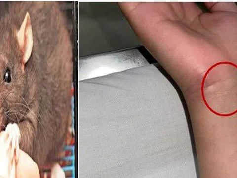 Cảnh báo bệnh lý nguy hiểm khi bị chuột cắn